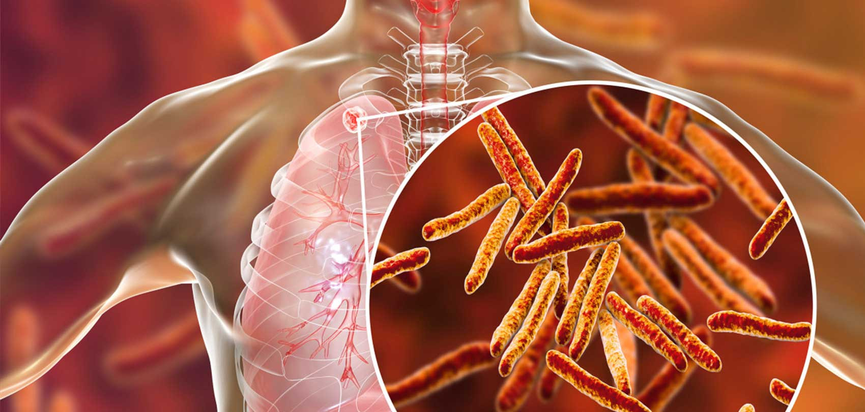 विश्व क्षयरोग दिवसः नेपालमा ३२ हजार क्षयरोगी उपचारबाट वञ्चित