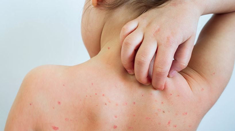 किर्गिजस्तानमा दादुराका बिरामी बढ्दै